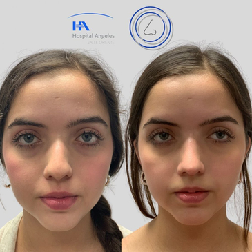 Slider image (4) Dr. Guillermo Guerra Gil de Leyva - Rhinoplasty Specialist